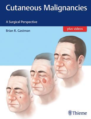 Read Online Cutaneous Malignancies: A Surgical Perspective - Brian Gastman | ePub